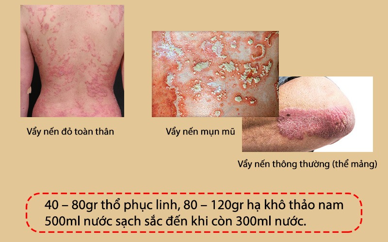 Chữa bệnh vẩy nến bằng củ thổ phục linh