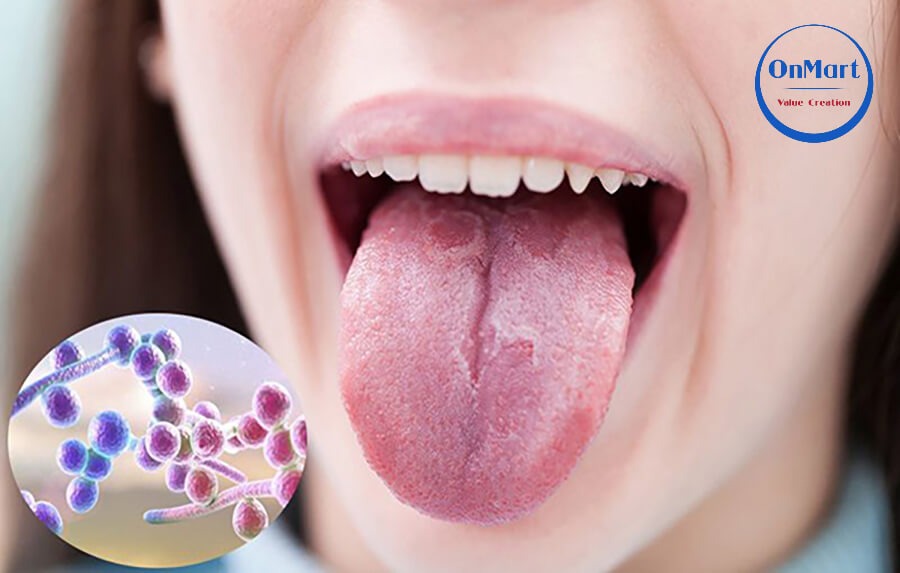 Lợi ích của gạo lứt trong điều trị nhiễm nấm candida Lợi ích của gạo lứt trong điều trị nhiễm nấm candida