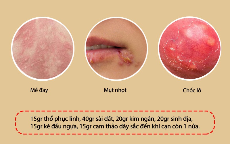 Thổ phục linh trị mề đay, mụn nhọt, chốc lỡ